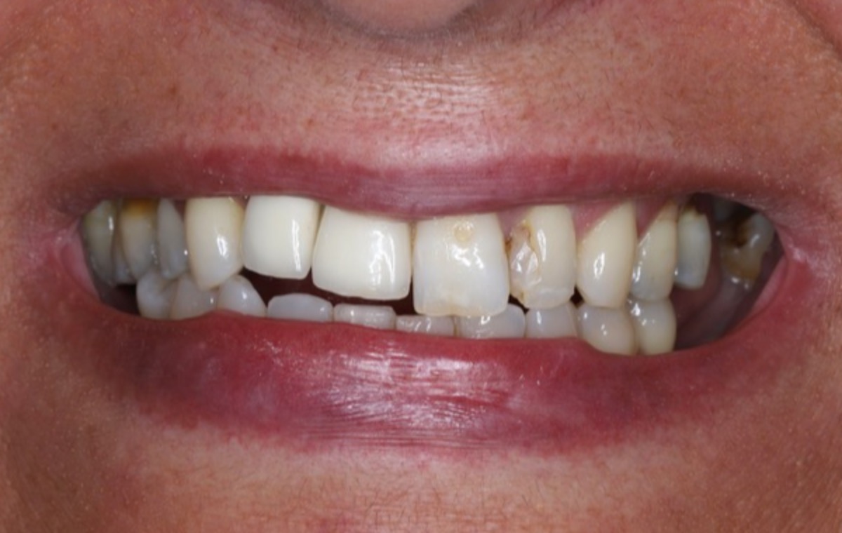 Antes | Reabilitação Estética com Implantes e Facetas de Cerâmica