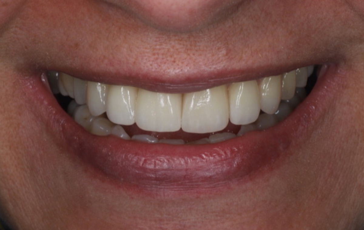 Depois | Reabilitação Estética com Implantes e Facetas de Cerâmica